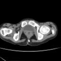 Colocolic fistula - Crohn disease (Radiopaedia 57063-63955 A 93).jpg