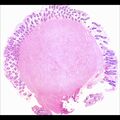 Colon leiomyoma (histology) (Radiopaedia 78118).jpeg