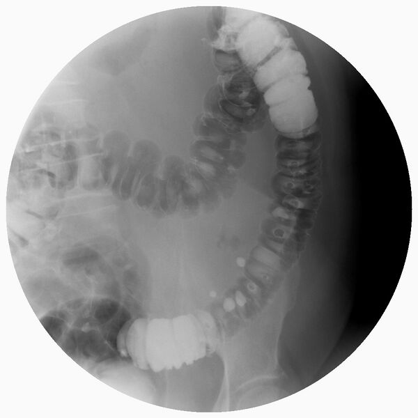 File:Colonic diverticulosis on single and double contrast barium enema (Radiopaedia 42254-45340 Double contrast 3).jpg