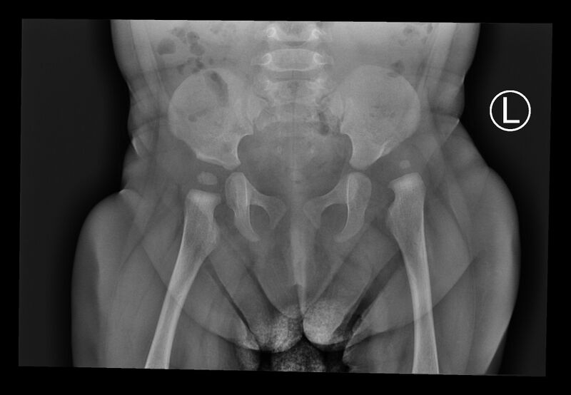 File:Developmental dysplasia of the hip (Radiopaedia 70420).jpg