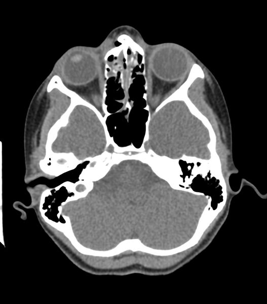 File:Nasoorbitoethmoid fracture (Radiopaedia 90044-107205 Axial non-contrast 156).jpg