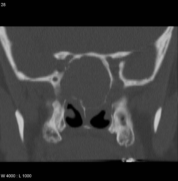 File:Nasopharyngeal carcinoma (recurrent) (Radiopaedia 5061-6903 Coronal bone window 7).jpg