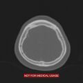 Nasopharyngeal carcinoma recurrence - skull base destruction (Radiopaedia 29107-29490 Axial bone window 17).jpg