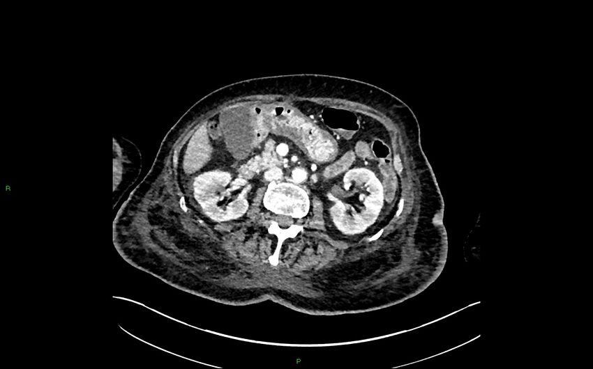 Neo-terminal ileal stricture (Crohn disease) (Radiopaedia 33790-34948 A 174).jpg