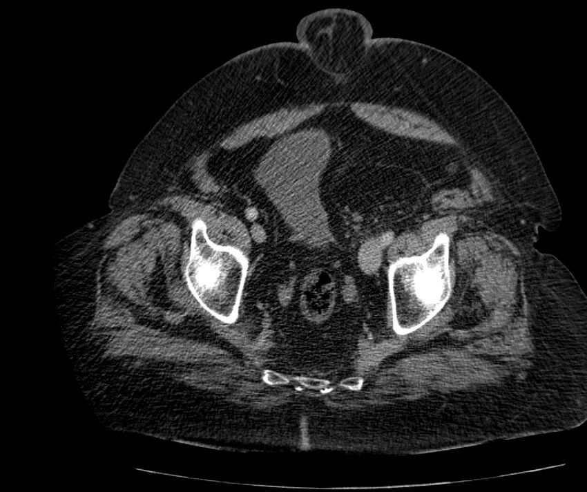 Nephroptosis with inguinal hernia containing perirenal fat (Radiopaedia 56632-63391 C 297).jpg