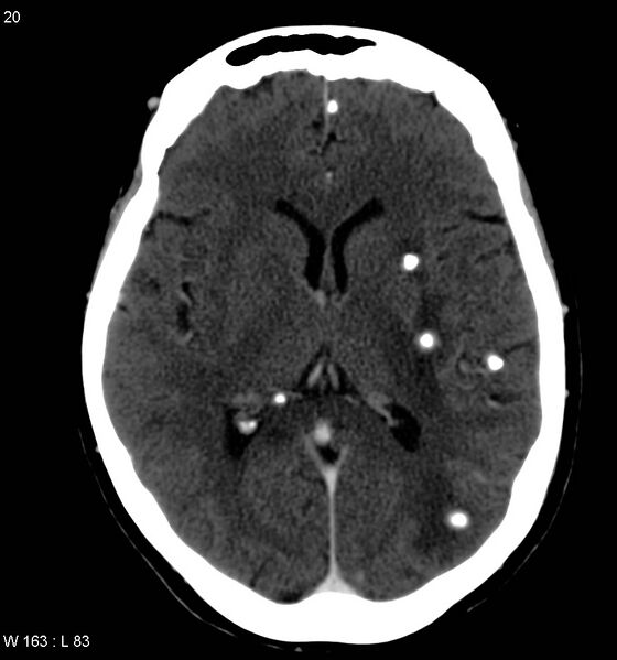 File:Neurocysticercosis (Radiopaedia 7773-8596 C+ delayed 8).jpg