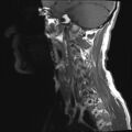 Neurofibromatosis type 1 (Radiopaedia 80355-93740 Sagittal T1 10).jpg