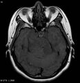 Neurofibromatosis type 2 - cranial and spinal involvement (Radiopaedia 5351-7111 Axial T1 1).jpg