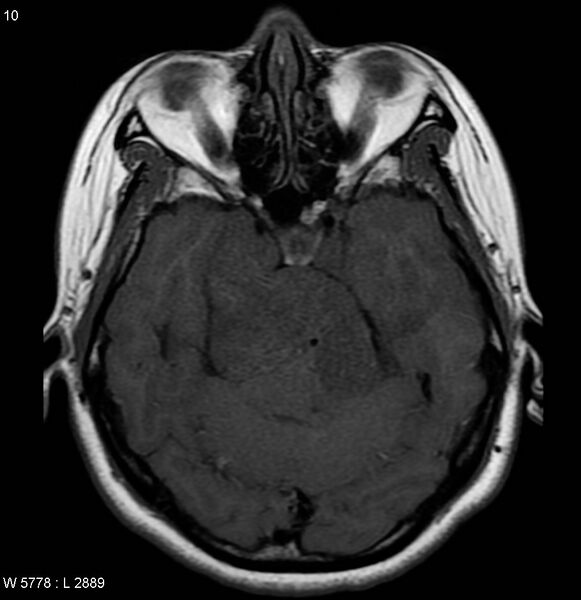 File:Neurofibromatosis type 2 - cranial and spinal involvement (Radiopaedia 5351-7111 Axial T1 1).jpg