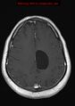 Neuroglial cyst (Radiopaedia 10713-11184 Axial T1 C+ 7).jpg