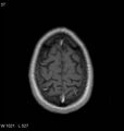 Neurosarcoidosis (Radiopaedia 10930-11351 Axial T1 C+ 18).jpg