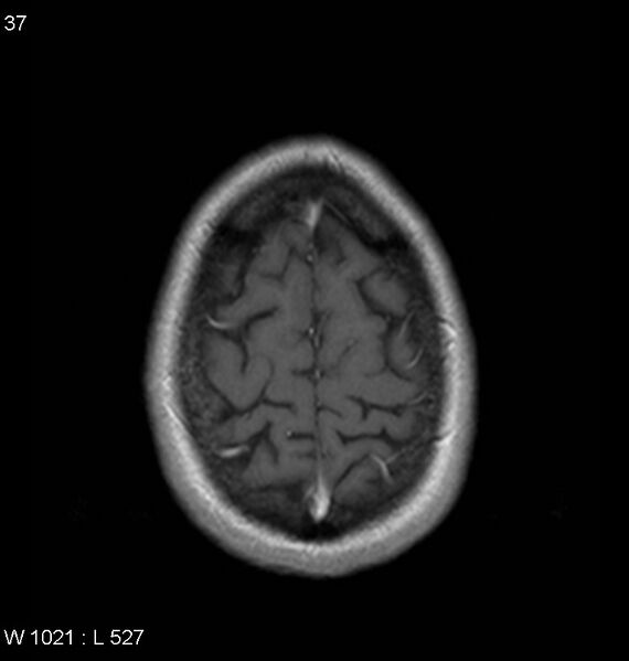 File:Neurosarcoidosis (Radiopaedia 10930-11351 Axial T1 C+ 18).jpg