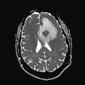 Neurotoxoplasmosis - concentric target sign (Radiopaedia 70644-80784 Axial ADC 14).jpg