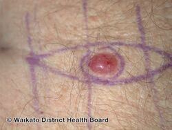 Nodular melanoma (DermNet NZ nm10).jpg