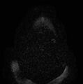 Non-Hodgkin lymphoma - parotid gland (Radiopaedia 71531-81890 Axial DWI 1).jpg