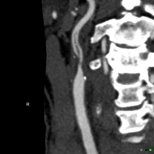 File:Non-occlusive intraluminal internal carotid artery thrombus (Radiopaedia 37751-39658 A 71).jpg
