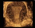 Normal 3D uterus (Radiopaedia 34301-35588 A 1).jpg