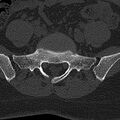 Normal CT lumbar spine (Radiopaedia 53981-60118 Axial bone window 65).jpg