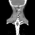 Normal CT of the neck (Radiopaedia 14575-14500 Coronal C+ 42).jpg