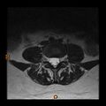 Normal spine MRI (Radiopaedia 77323-89408 Axial T2 14).jpg