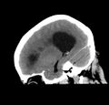 Obstructive hydrocephalus (Radiopaedia 30453-31119 C 24).jpg