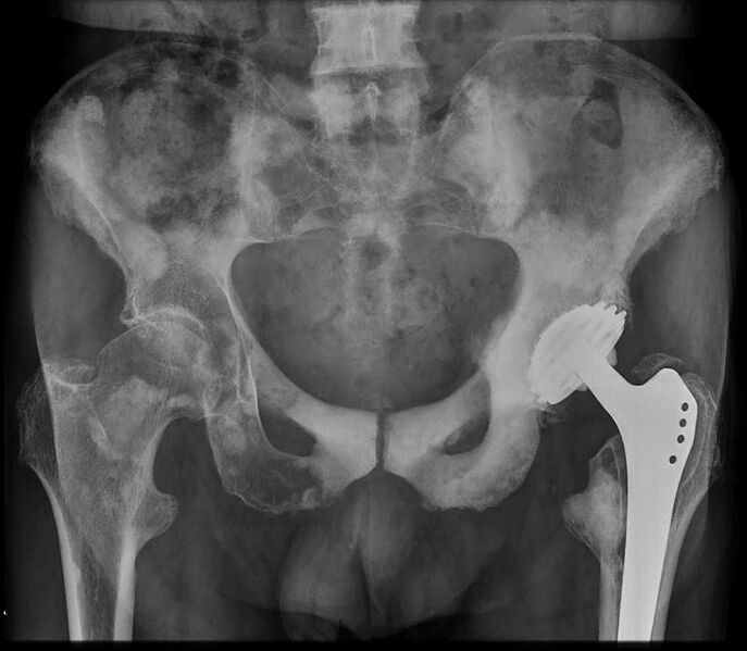 File:Osteoblastic metastases (prostate carcinoma) (Radiopaedia 10058).jpg