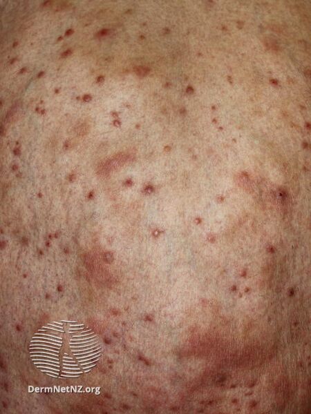 File:Primary cutaneous anaplastic large cell lymphoma (DermNet NZ primary-cutaneous-anaplastic-large-cell-lymphoma-02).jpg