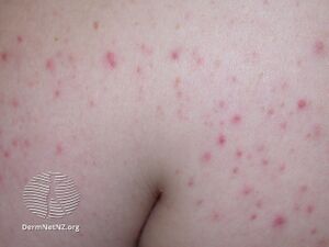 Steroid-induced acne