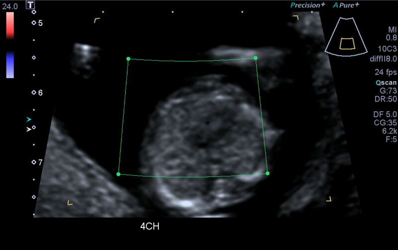 File:1st trimester nuchal-morphology ultrasound (Radiopaedia 44706-48477 Heart views cine with colour 45).jpg