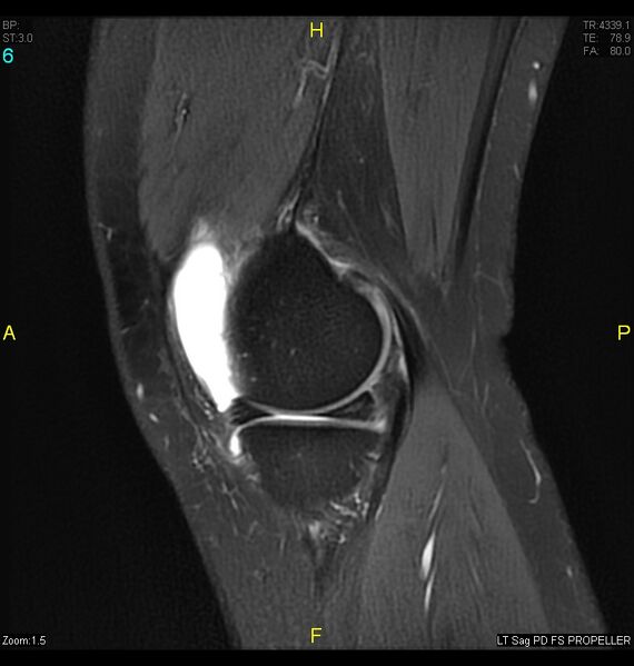 File:ACL mucoid degeration with cystic changes (Radiopaedia 48428-53341 Sagittal PD fat sat 4).jpg