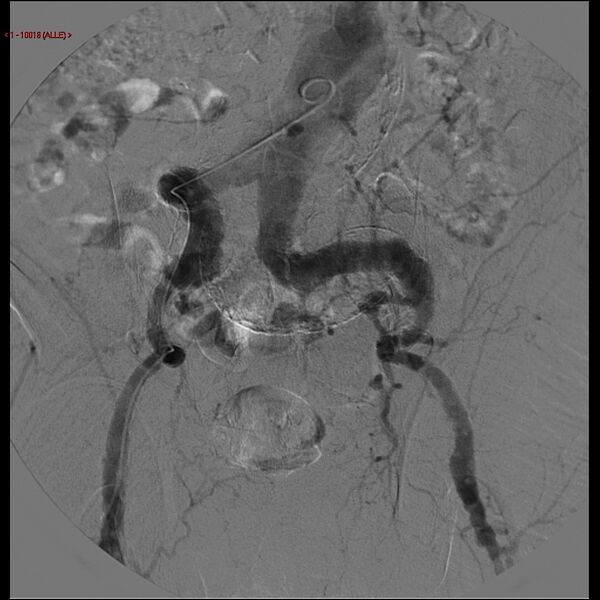 File:Abdominal aortic aneurysm (Radiopaedia 16155-15833 Frontal Aorta 12).jpg