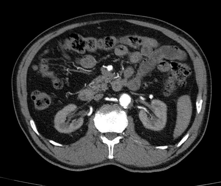 File:Abdominal aortic aneurysm (Radiopaedia 22421-22458 C+ arterial phase 31).jpg