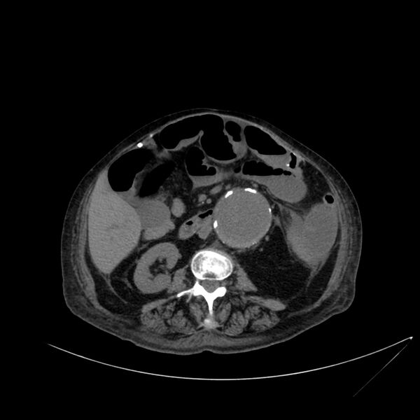 File:Abdominal aortic aneurysm - impending rupture (Radiopaedia 19233-19246 Axial non-contrast 64).jpg