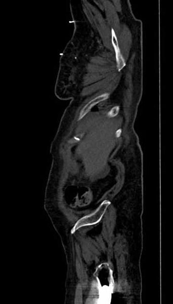 File:Abdominal aortic aneurysm with thrombus fissuration (Radiopaedia 73192-83919 Sagittal C+ arterial phase 132).jpg