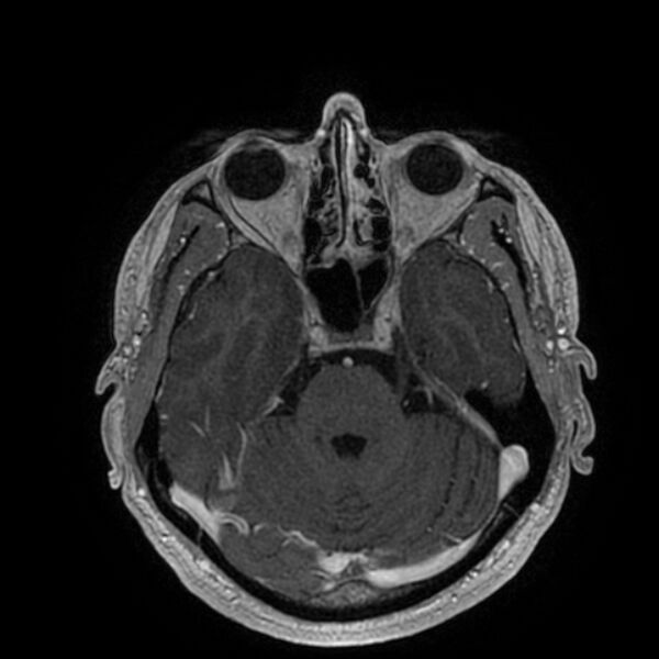 File:Acoustic schwannoma - intracanalicular (Radiopaedia 37247-39024 Axial T1 C+ 82).jpg