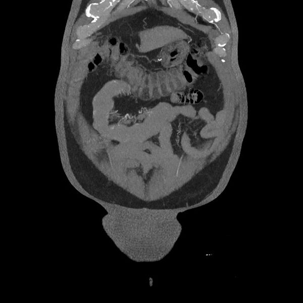 File:Active colonic bleed on CT (Radiopaedia 49765-55025 Coronal art MIP 14).jpg