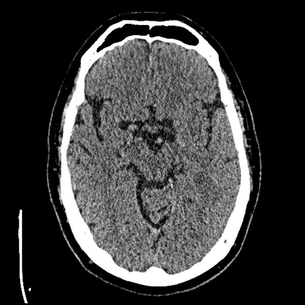 File:Acute A3 occlusion with ACA ischemic penumbra (CT perfusion) (Radiopaedia 72036-82525 Axial non-contrast thins 13).jpg