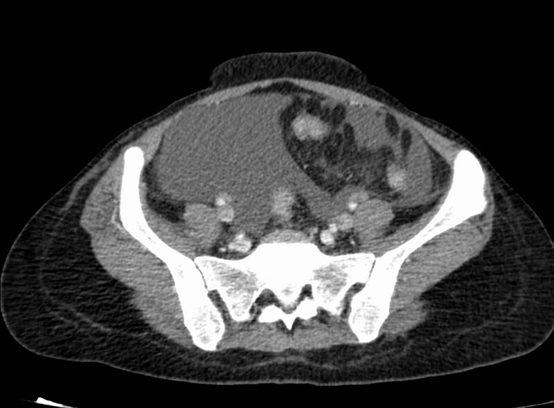 File:Acute Budd-Chiari syndrome (Radiopaedia 60858-68638 Axial C+ portal venous phase 227).jpg