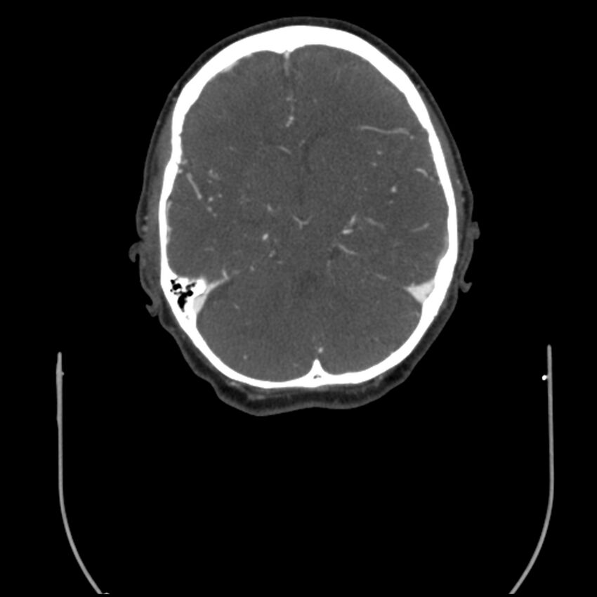 Acute M1 occlusion with ischemic penumbra (CT perfusion) (Radiopaedia 71897-82344 Axial C+ arterial phase thins 77).jpg