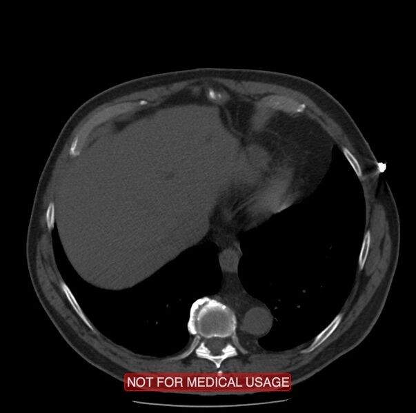 File:Acute aortic dissection - Stanford type A (Radiopaedia 40661-43285 Axial non-contrast 57).jpg