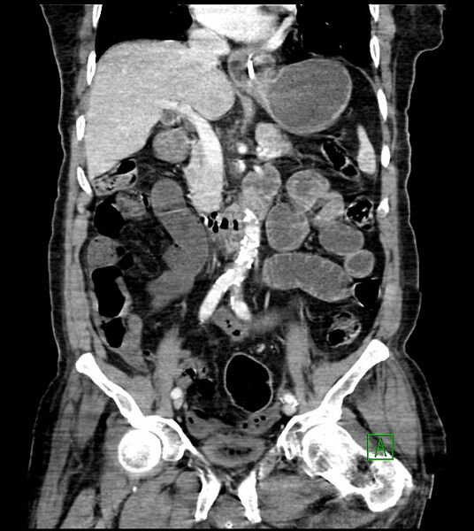 File:Acute arterial mesenteric ischemia (Radiopaedia 78238-90828 Coronal C+ portal venous phase 48).jpg