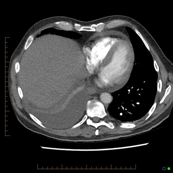 File:Acute hemorrhage into adrenal metastasis from NSCLC (Radiopaedia 43135-46429 Axial C+ CTPA 4).jpg