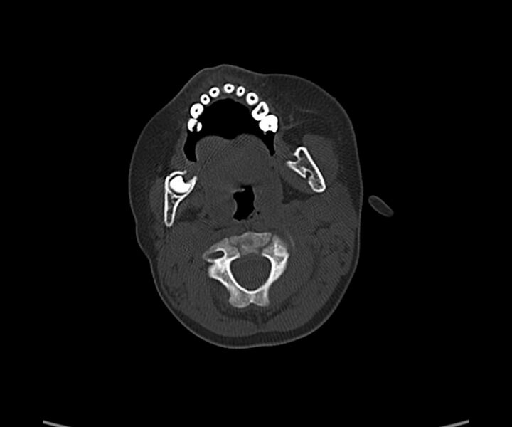 File:Acute hemorrhagic contusion (Radiopaedia 63660-72336 Axial bone window 2).jpg