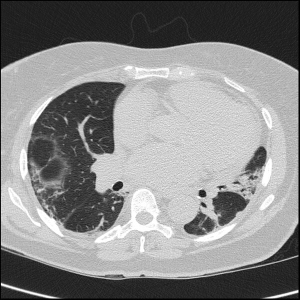 File:Acute interstitial pneumonitis (Radiopaedia 45404-49453 Axial lung window 47).jpg