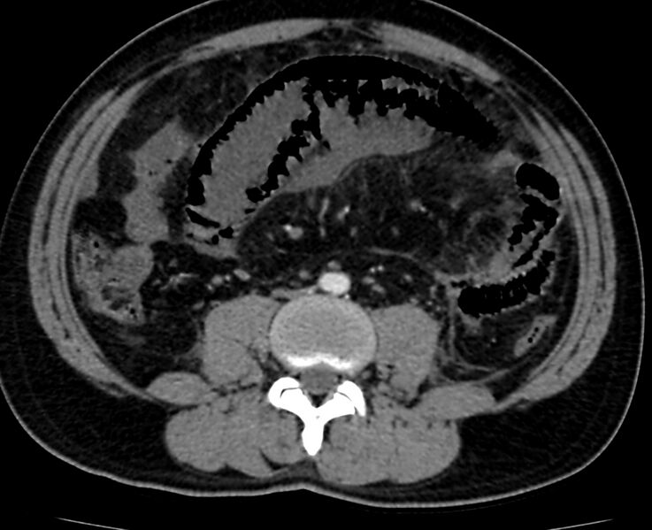File:Acute mesenteric ischemia - superior mesenteric artery thrombosis (Radiopaedia 73947-84776 Axial C+ arterial phase 83).jpg