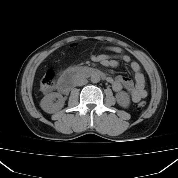 File:Acute pancreatitis (Radiopaedia 22572-22596 Axial non-contrast 31).jpg