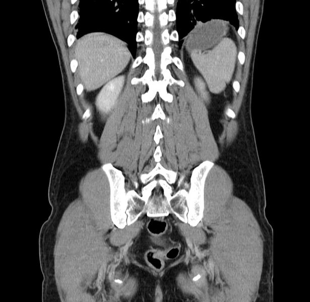 File:Acute pancreatitis (Radiopaedia 22572-22596 Coronal C+ portal venous phase 43).jpg