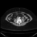 Acute pancreatitis - Balthazar C (Radiopaedia 26569-26714 Axial C+ arterial phase 57).jpg