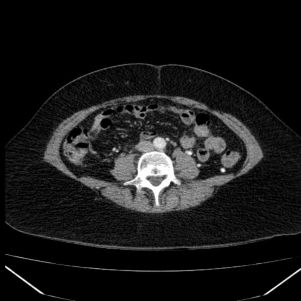File:Acute pancreatitis - Balthazar C (Radiopaedia 26569-26714 Axial C+ arterial phase 57).jpg