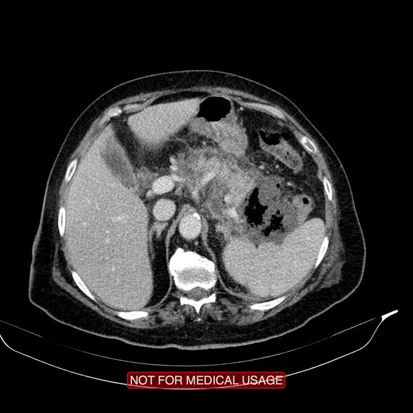 File:Acute pancreatitis with infected necrosis (Radiopaedia 26454-26585 Axial C+ portal venous phase 5).jpg